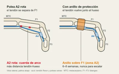 Anillo para la polea del dedo: cuándo usarlo, cuánto tiempo y cómo elegir la talla