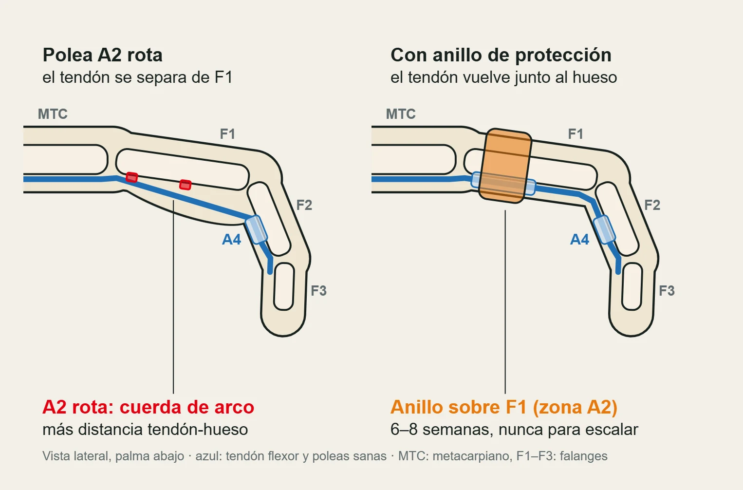 Vista lateral del dedo: con la polea A2 rota el tendón flexor se separa de la primera falange; con el anillo de protección vuelve junto al hueso