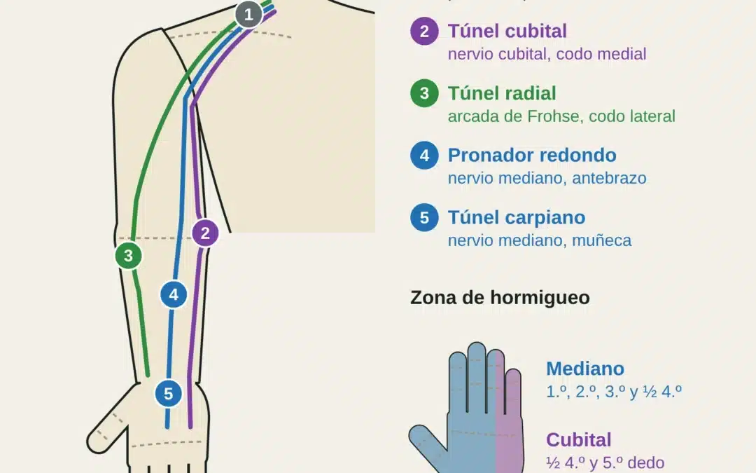 Vista anterior del miembro superior con los cinco puntos de atrapamiento nervioso y la zona de hormigueo del mediano y del cubital.