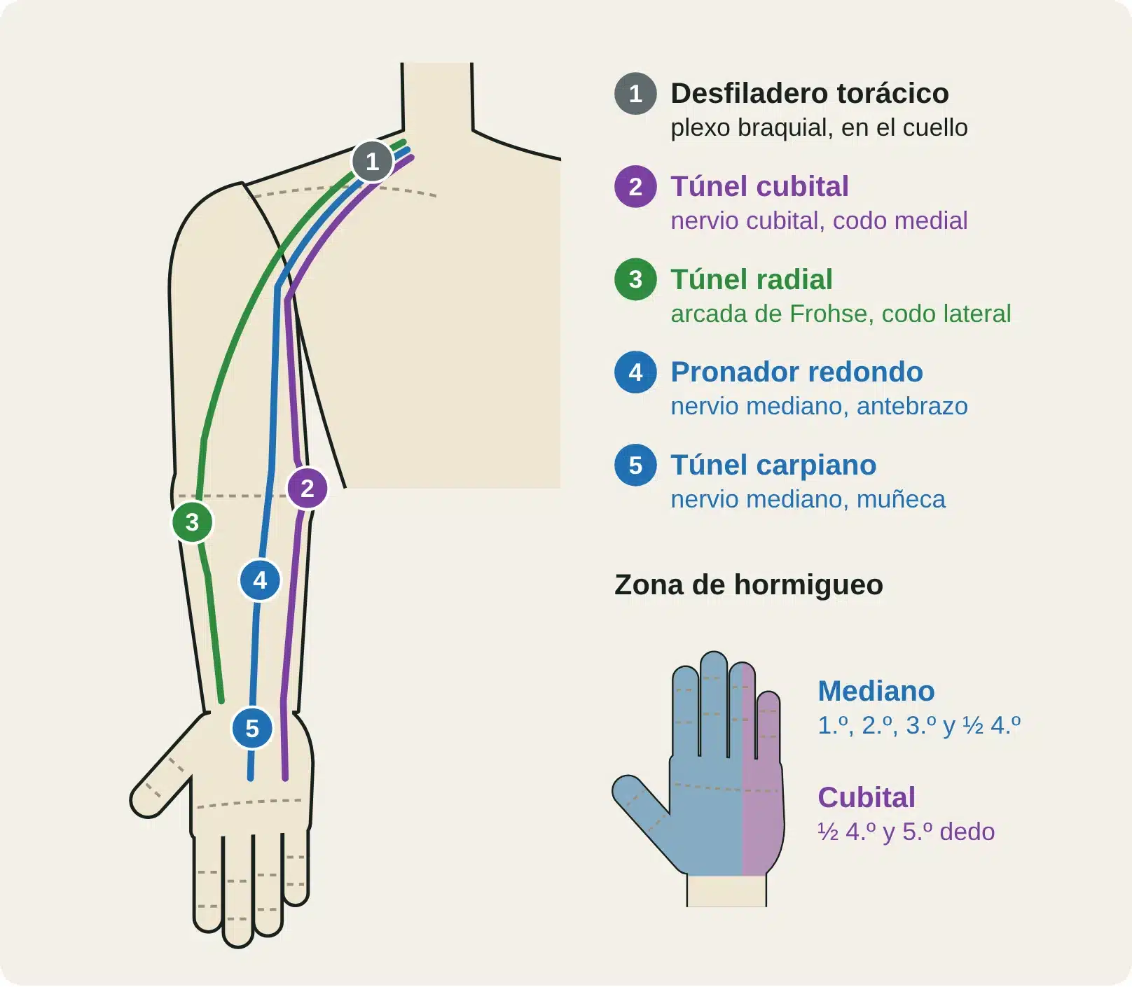 Vista anterior del miembro superior con los cinco puntos de atrapamiento nervioso y la zona de hormigueo del mediano y del cubital.