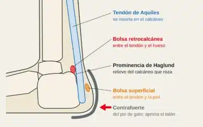 Bursitis retroaquílea y deformidad de Haglund en escaladores: dolor en el talón por el pie de gato