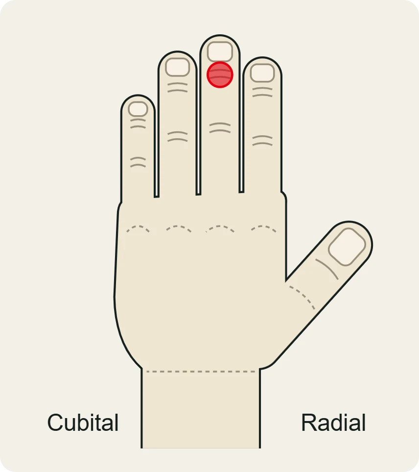 Capsulitis de la IFD: dolor en la articulación de la punta del dedo, vista dorsal.