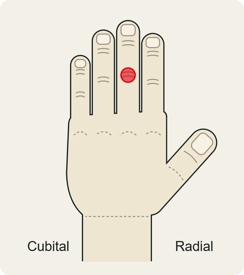 Capsulitis de la IFP: dolor e hinchazón en la articulación media del dedo, vista dorsal.