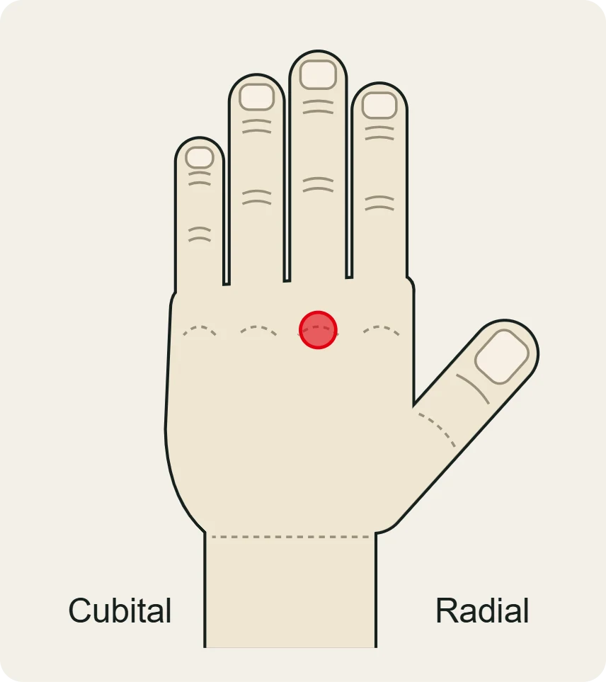 Capsulitis de la MCF: dolor en el nudillo de la base del dedo, vista dorsal.