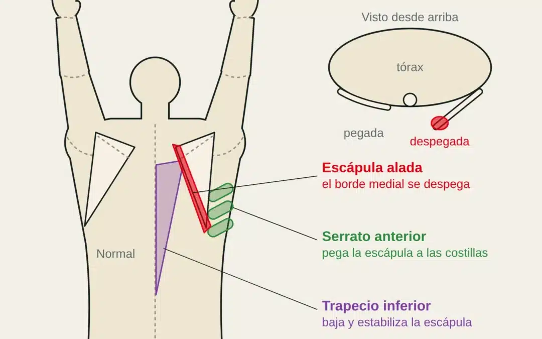 Vista posterior de la espalda con los brazos elevados: las escápulas rotan hacia arriba y la derecha despega su borde medial (escápula alada); serrato anterior y trapecio inferior.