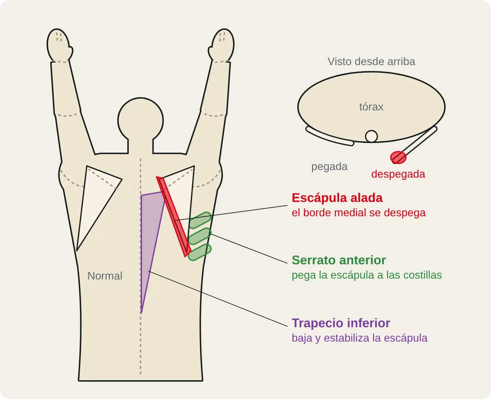 Vista posterior de la espalda con los brazos elevados: las escápulas rotan hacia arriba y la derecha despega su borde medial (escápula alada); serrato anterior y trapecio inferior.