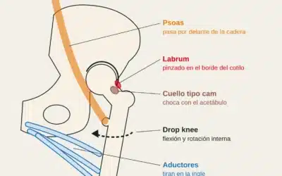 Dolor de cadera en escalada: pinzamiento, labrum, aductores y psoas