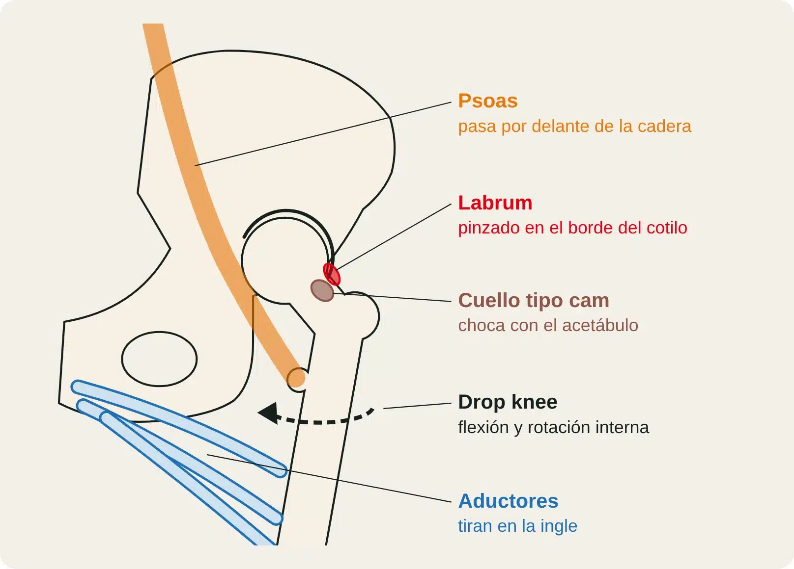 Vista frontal de la cadera en drop knee: el cuello femoral tipo cam choca con el acetábulo y pinza el labrum.
