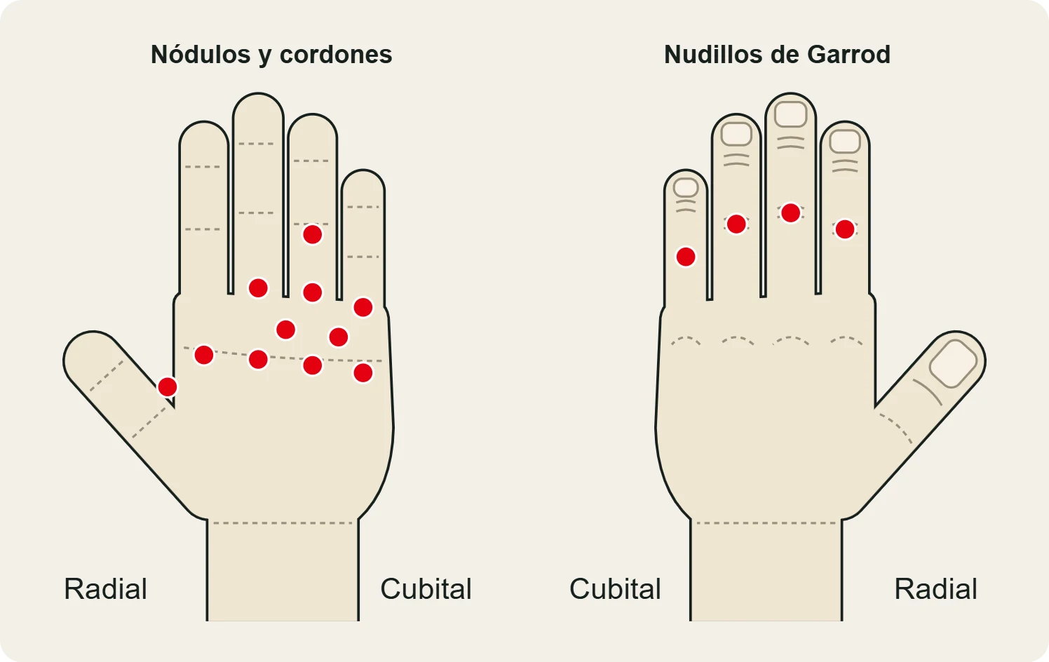 Dónde aparece el Dupuytren: nódulos y cordones en la palma, los dedos y las comisuras, y nudillos de Garrod en el dorso.