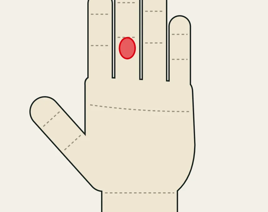 Lesión del flexor superficial: dolor palmar en la primera falange, hacia la articulación media.
