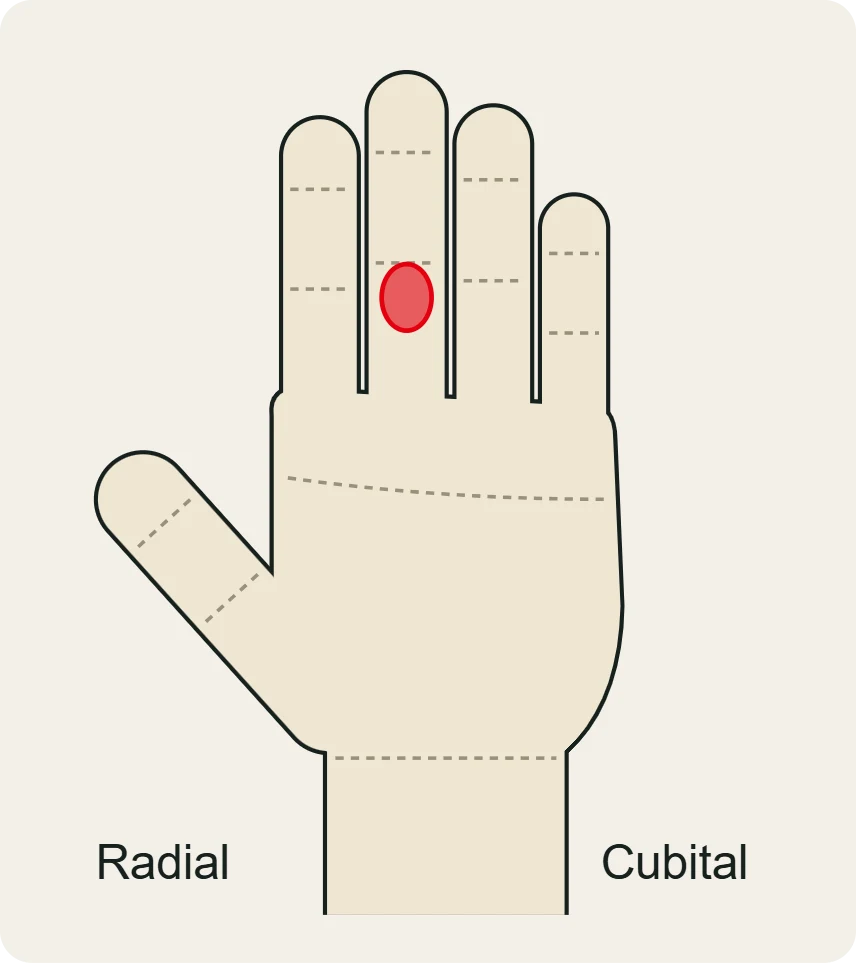 Lesión del flexor superficial: dolor palmar en la primera falange, hacia la articulación media.