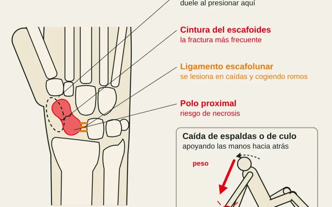 Vista dorsal de la muñeca con el escafoides, la tabaquera anatómica y el ligamento escafolunar (que también se lesiona cogiendo romos), y el mecanismo: caída de espaldas apoyando las manos hacia atrás con las muñecas en extensión forzada.