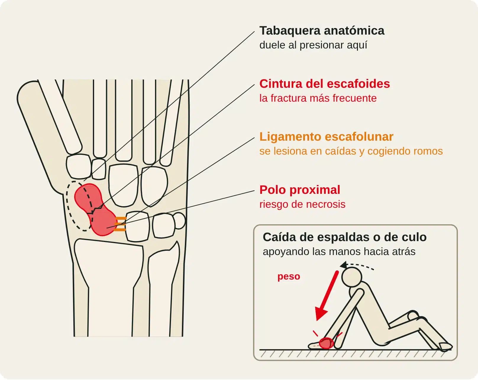 Vista dorsal de la muñeca con el escafoides, la tabaquera anatómica y el ligamento escafolunar (que también se lesiona cogiendo romos), y el mecanismo: caída de espaldas apoyando las manos hacia atrás con las muñecas en extensión forzada.