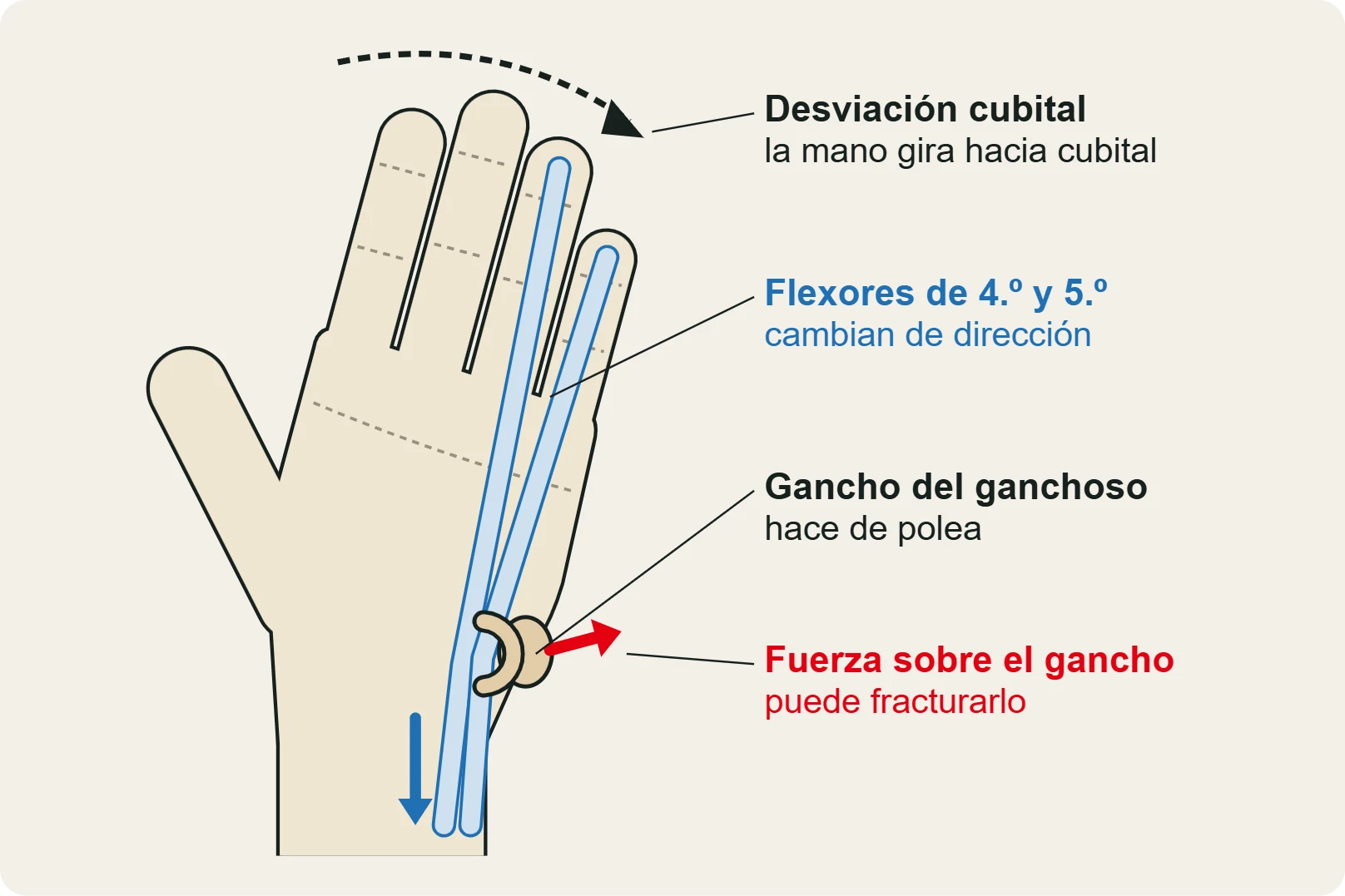 El mecanismo: en el invertido lateral, con la muñeca en supinación y desviación cubital, los flexores del 4.º y 5.º dedo hacen polea sobre el gancho.