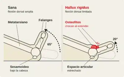 Hallux rigidus en escaladores: artrosis del dedo gordo del pie y pies de gato