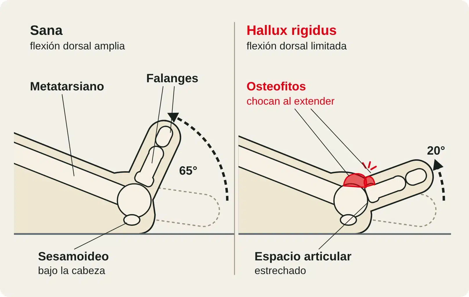 Vista medial del primer radio del pie: articulación sana con flexión dorsal amplia frente a hallux rigidus con osteofitos dorsales que chocan y limitan la extensión.
