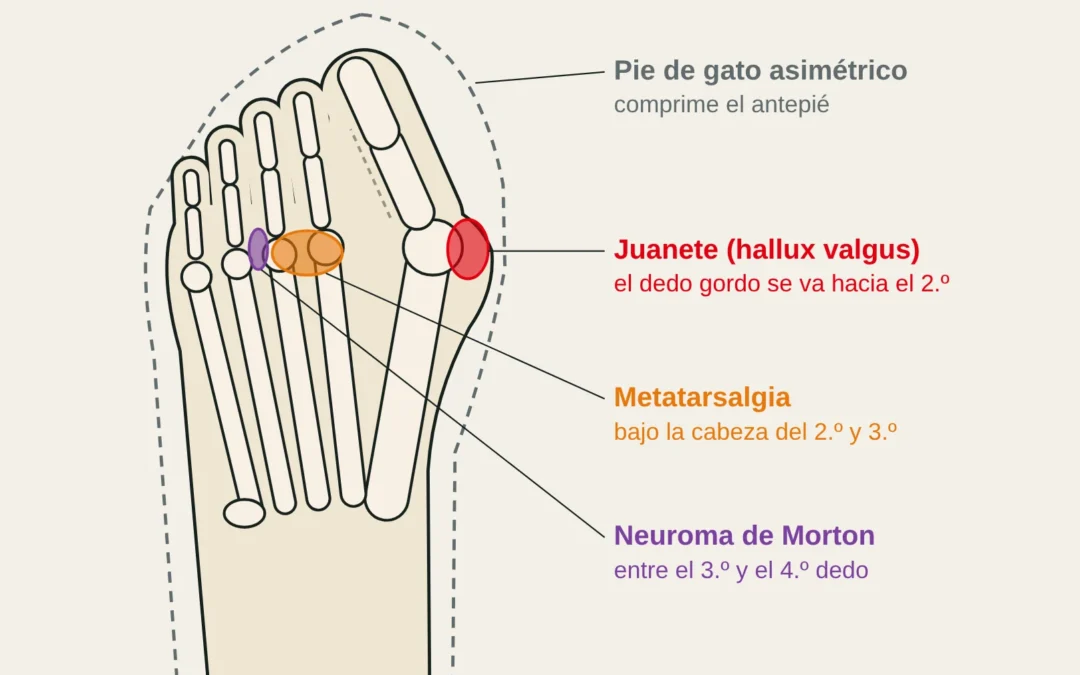 Vista dorsal del antepié dentro de un pie de gato asimétrico: juanete, metatarsalgia y neuroma de Morton.