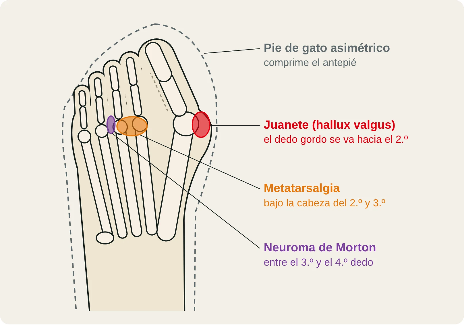 Vista dorsal del antepié dentro de un pie de gato asimétrico: juanete, metatarsalgia y neuroma de Morton.