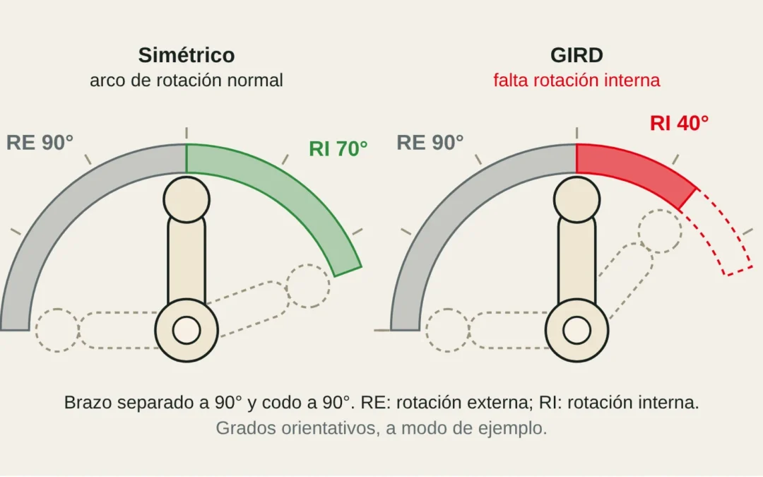 Esquema del arco de rotación del hombro a 90°: hombro simétrico frente a hombro con GIRD (pérdida de rotación interna).