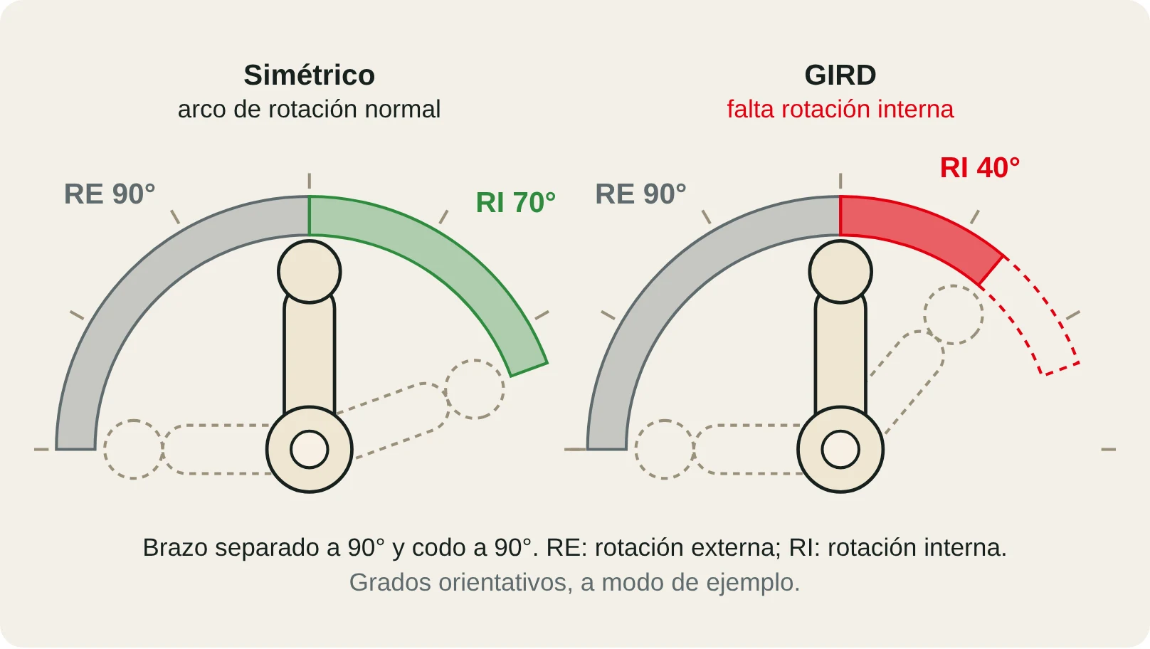 Esquema del arco de rotación del hombro a 90°: hombro simétrico frente a hombro con GIRD (pérdida de rotación interna).