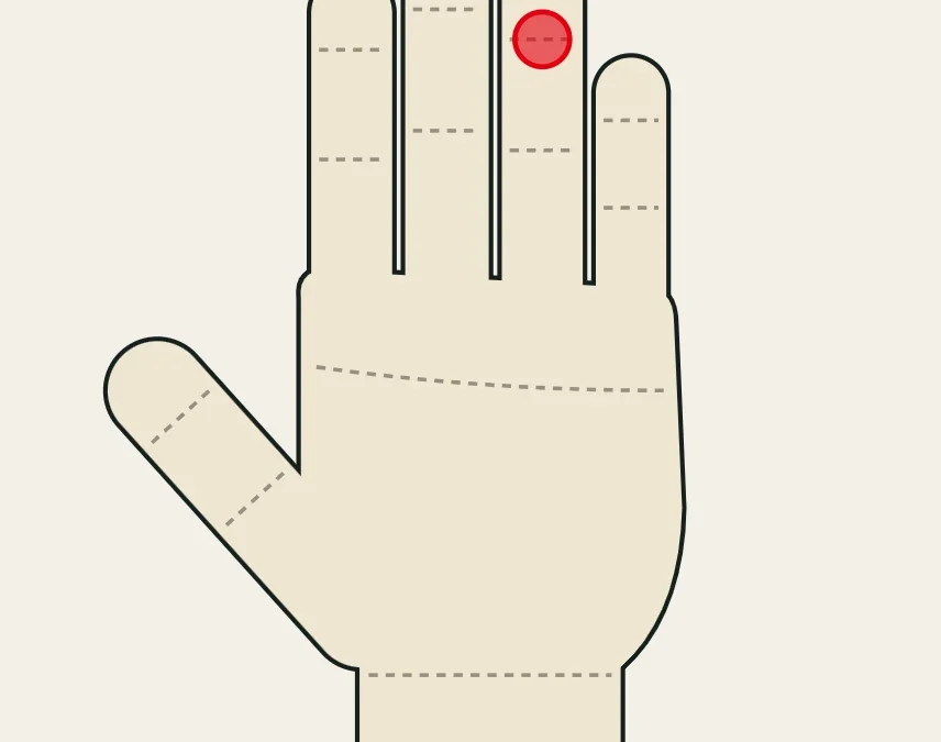 Jersey finger: dolor palmar en la articulación de la punta del dedo, típicamente en el anular.