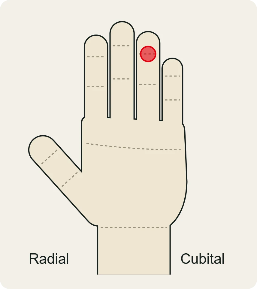 Jersey finger: dolor palmar en la articulación de la punta del dedo, típicamente en el anular.
