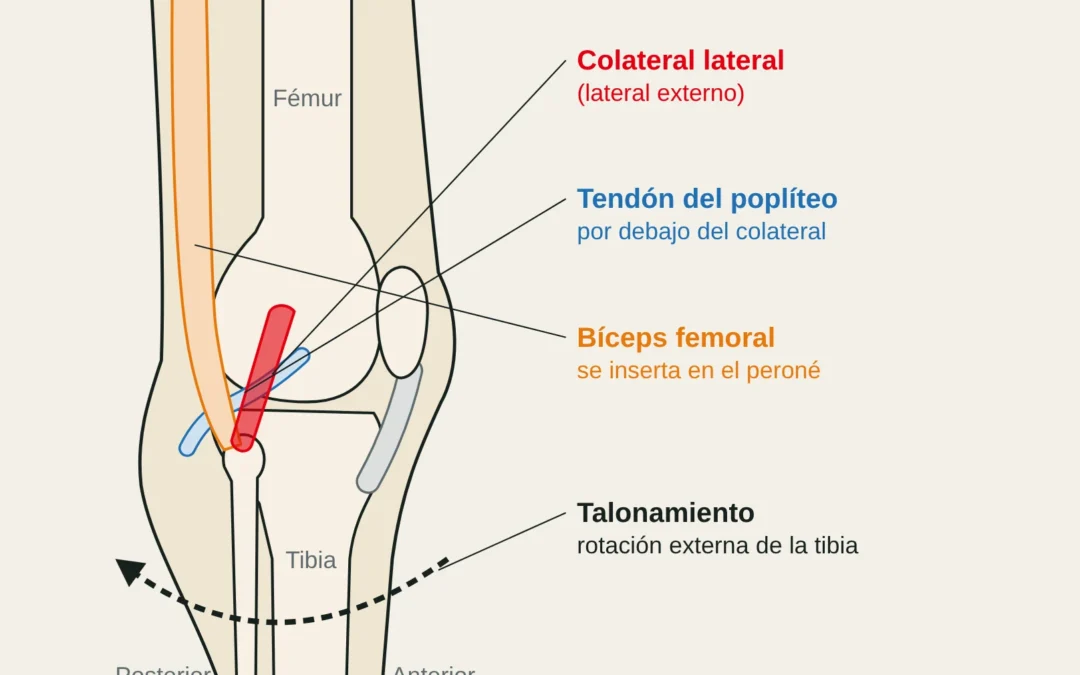 Vista lateral de la rodilla con el ligamento colateral lateral (lateral externo) y la rotación externa de la tibia que provoca el talonamiento.