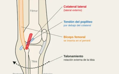 Lesión del ligamento lateral externo de la rodilla (colateral lateral) en escalada: talonamiento y esquina posterolateral