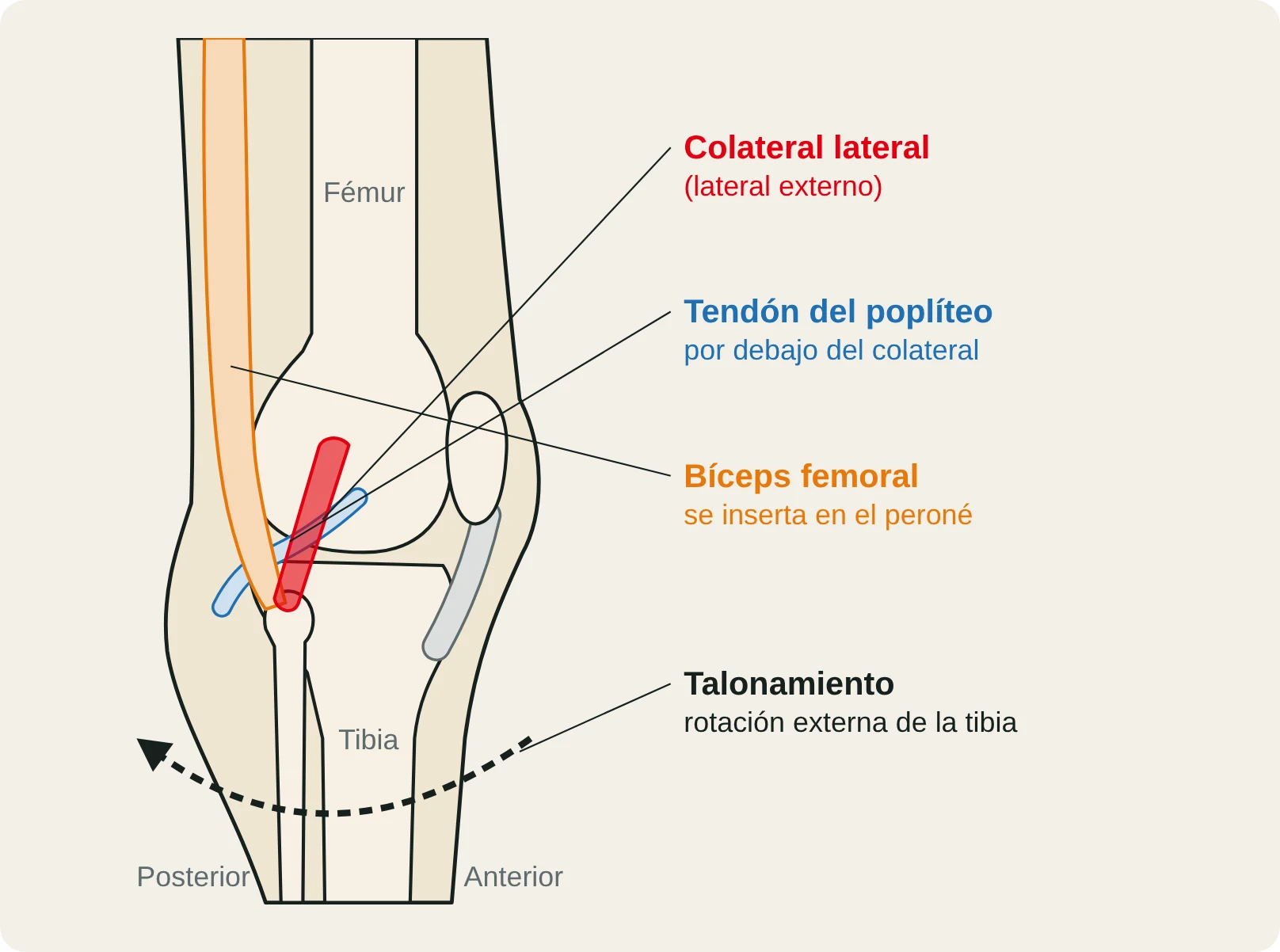 Vista lateral de la rodilla con el ligamento colateral lateral (lateral externo) y la rotación externa de la tibia que provoca el talonamiento.