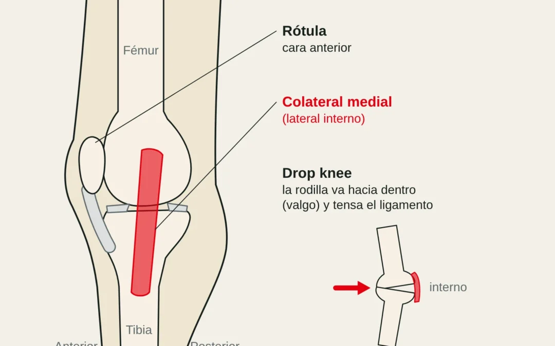 Vista medial de la rodilla con el ligamento colateral medial (lateral interno): en el drop knee la rodilla se va hacia dentro (valgo) y lo tensa.