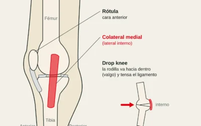 Lesión del ligamento lateral interno de la rodilla (colateral medial) en escalada: grados, tratamiento y plazos