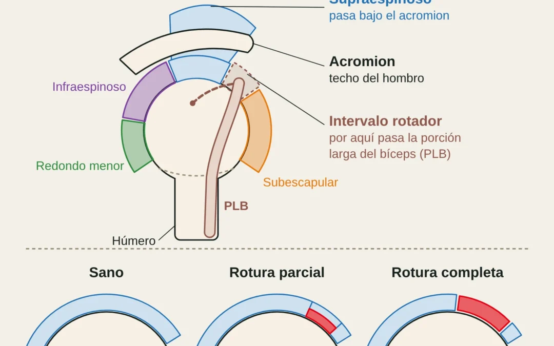 Vista lateral del hombro con el manguito rotador, el supraespinoso bajo el acromion y el intervalo rotador por el que pasa la porción larga del bíceps; debajo, tendón sano, rotura parcial y rotura completa.