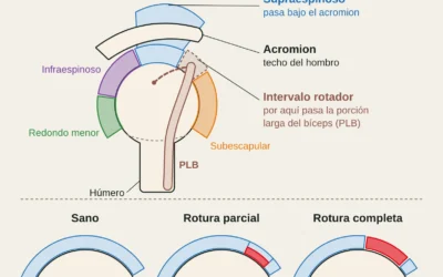 Lesión del manguito rotador en escaladores: tendinopatía, roturas y vuelta a escalar