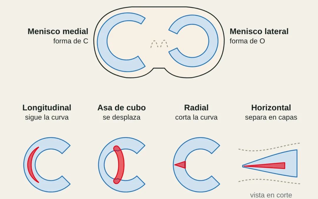 Vista superior de la meseta tibial con el menisco medial (en C) y el lateral (en O) y los cuatro tipos de rotura: longitudinal, asa de cubo, radial y horizontal.