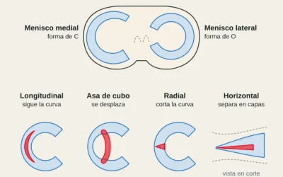 Lesión de menisco en escalada: drop knee, tipos de rotura y cuándo operar