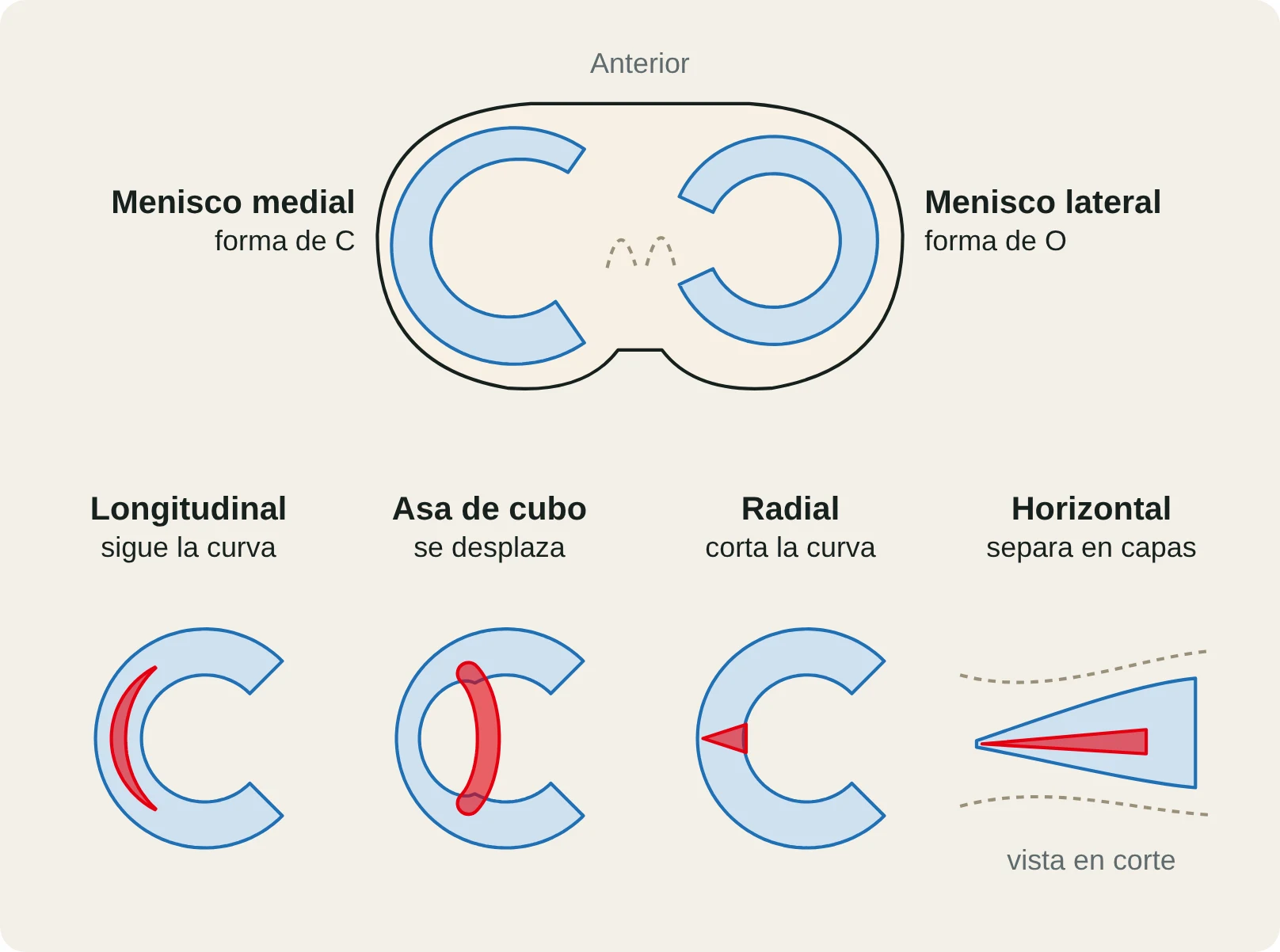 Vista superior de la meseta tibial con el menisco medial (en C) y el lateral (en O) y los cuatro tipos de rotura: longitudinal, asa de cubo, radial y horizontal.