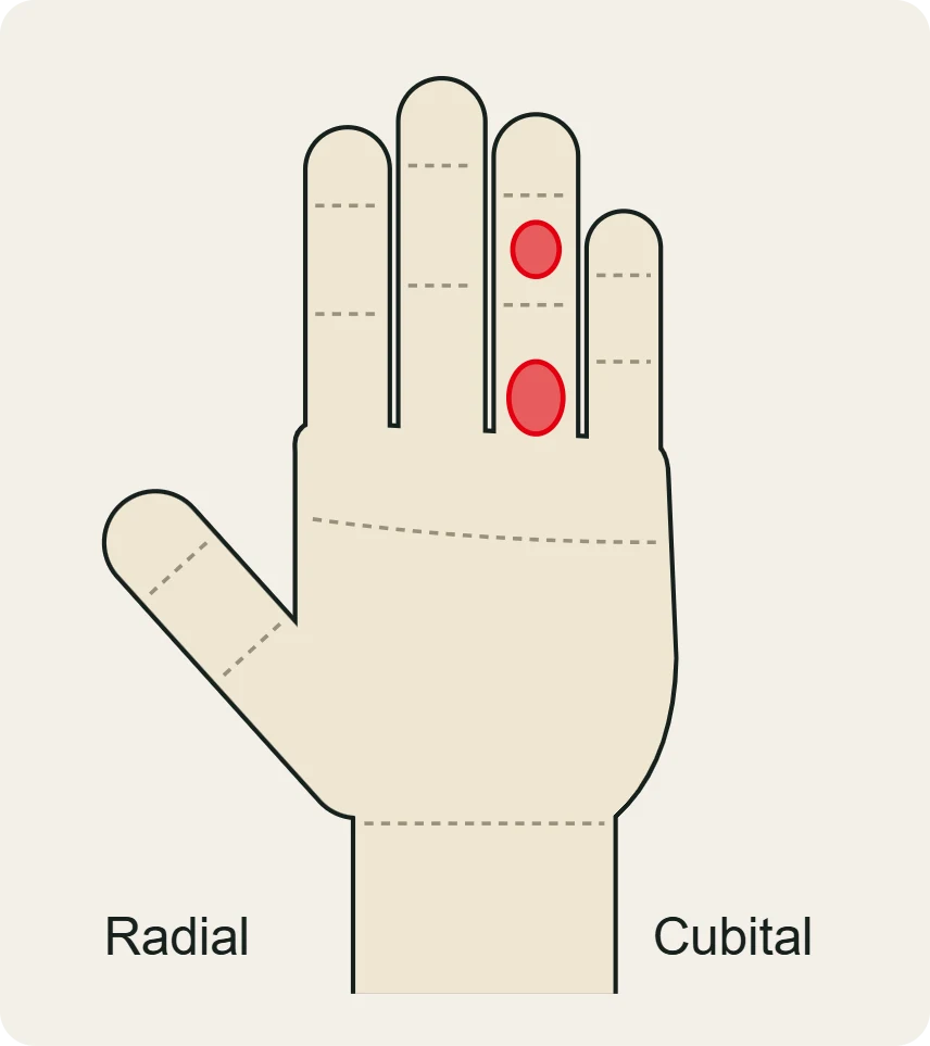 Dónde duele una lesión de polea: cara palmar de F1 (A2) y de F2 (A4), aquí en el anular.