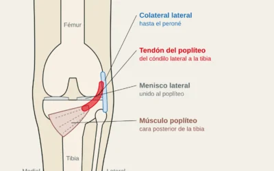 Lesión del poplíteo en escalada: dolor posterolateral de rodilla al talonar y en drop knee