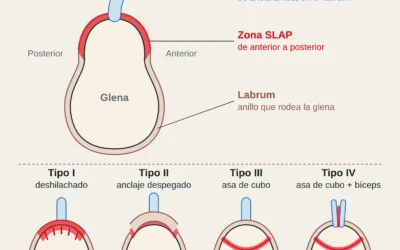 Lesión SLAP en escaladores: síntomas, diagnóstico y tratamiento con o sin cirugía