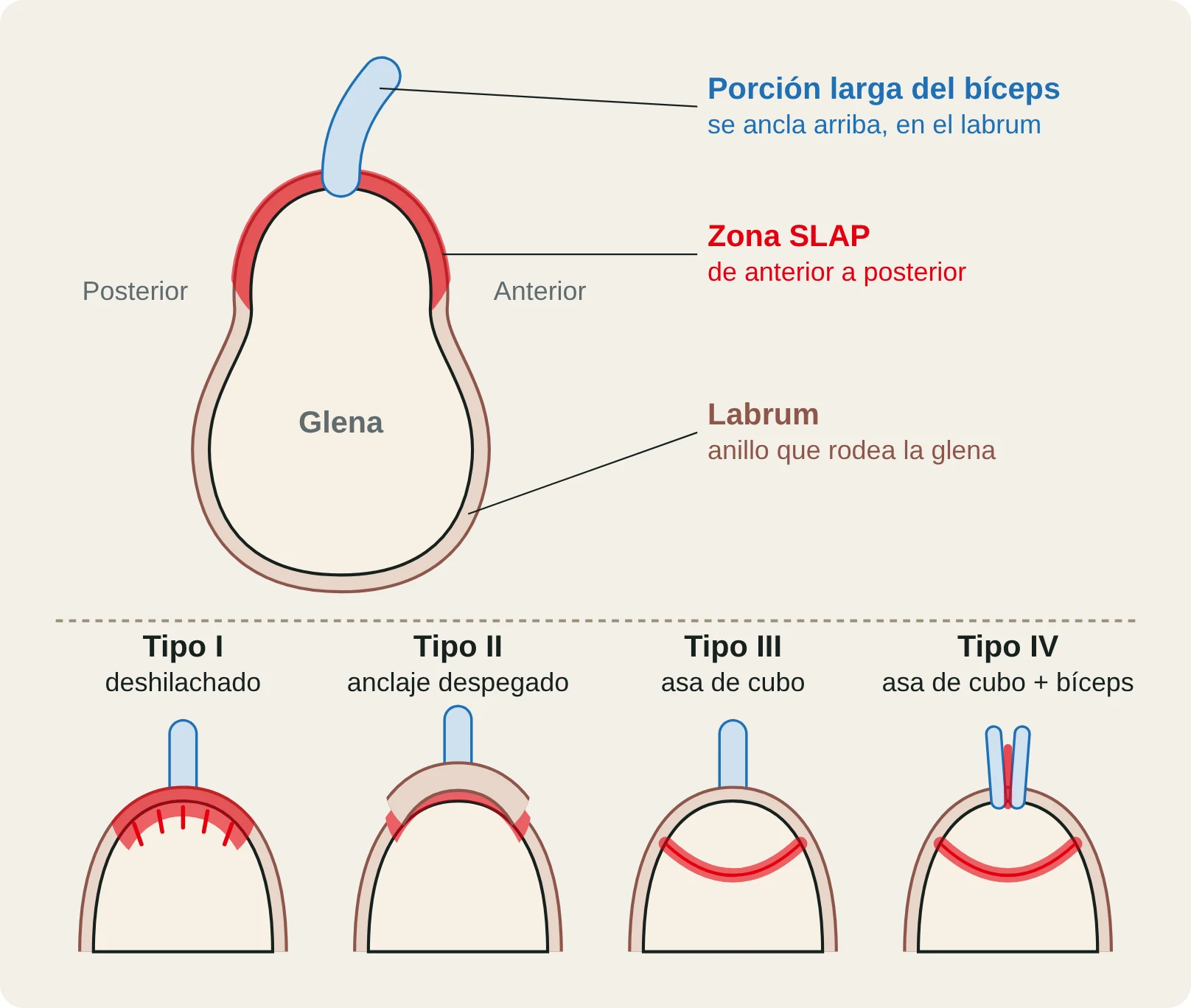 Vista frontal de la glena con el labrum y el anclaje del bíceps: la zona SLAP y los tipos I–IV de Snyder.
