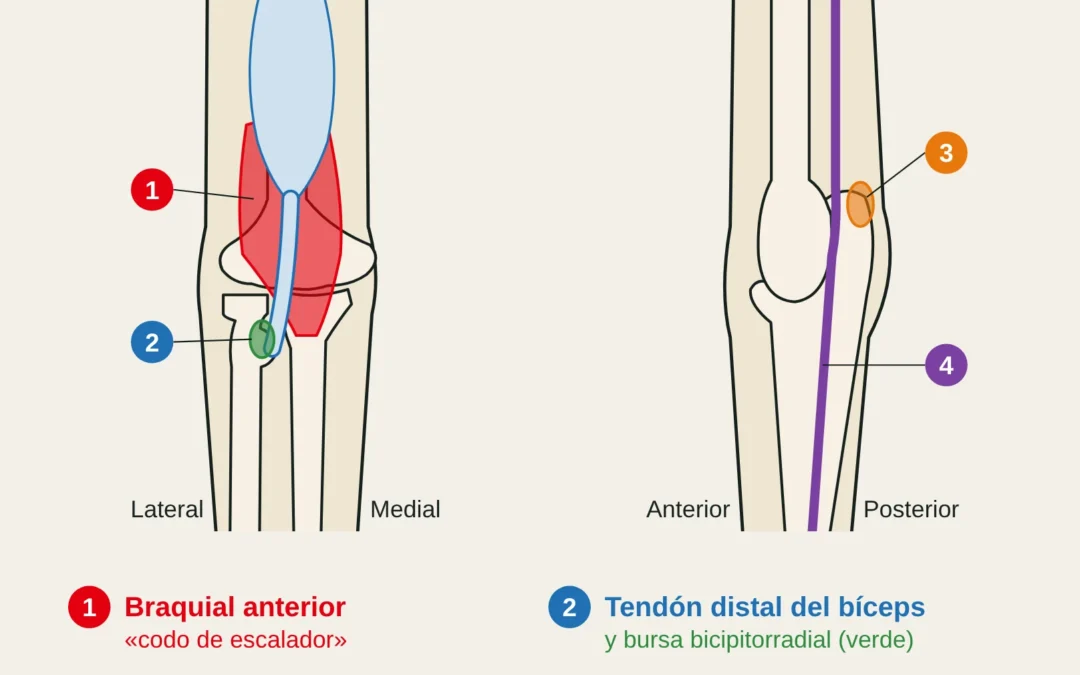 Vista anterior y medial del codo: braquial, tendón distal del bíceps con su bursa, zona posteromedial y nervio cubital.