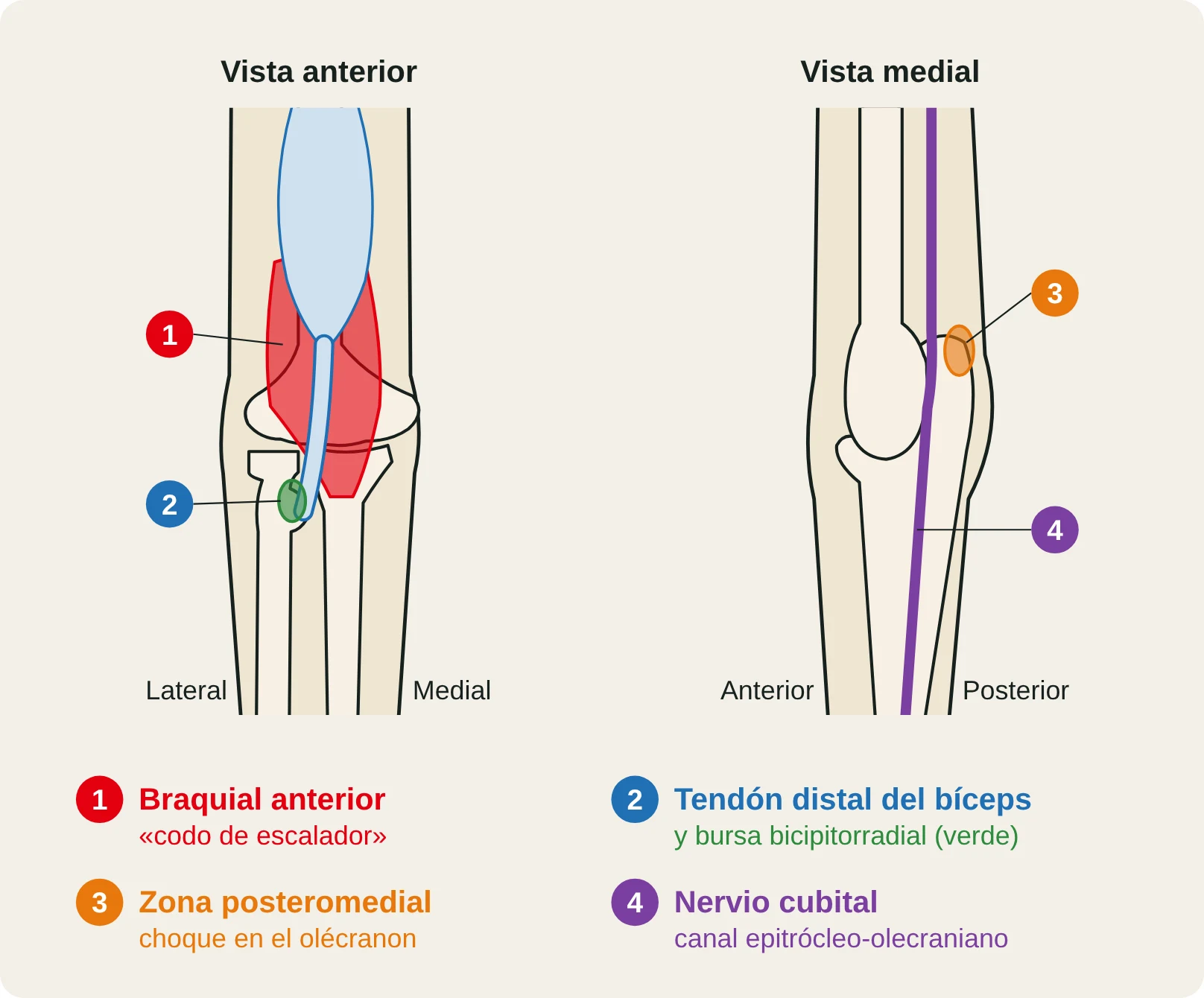 Dibujo de las lesiones del codo del escalador