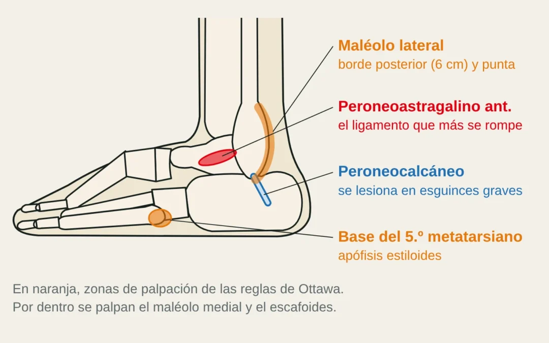 Vista lateral del tobillo con las zonas de palpación de las reglas de Ottawa (borde posterior y punta del maléolo lateral, base del 5.º metatarsiano), el ligamento peroneoastragalino anterior y el peroneocalcáneo.