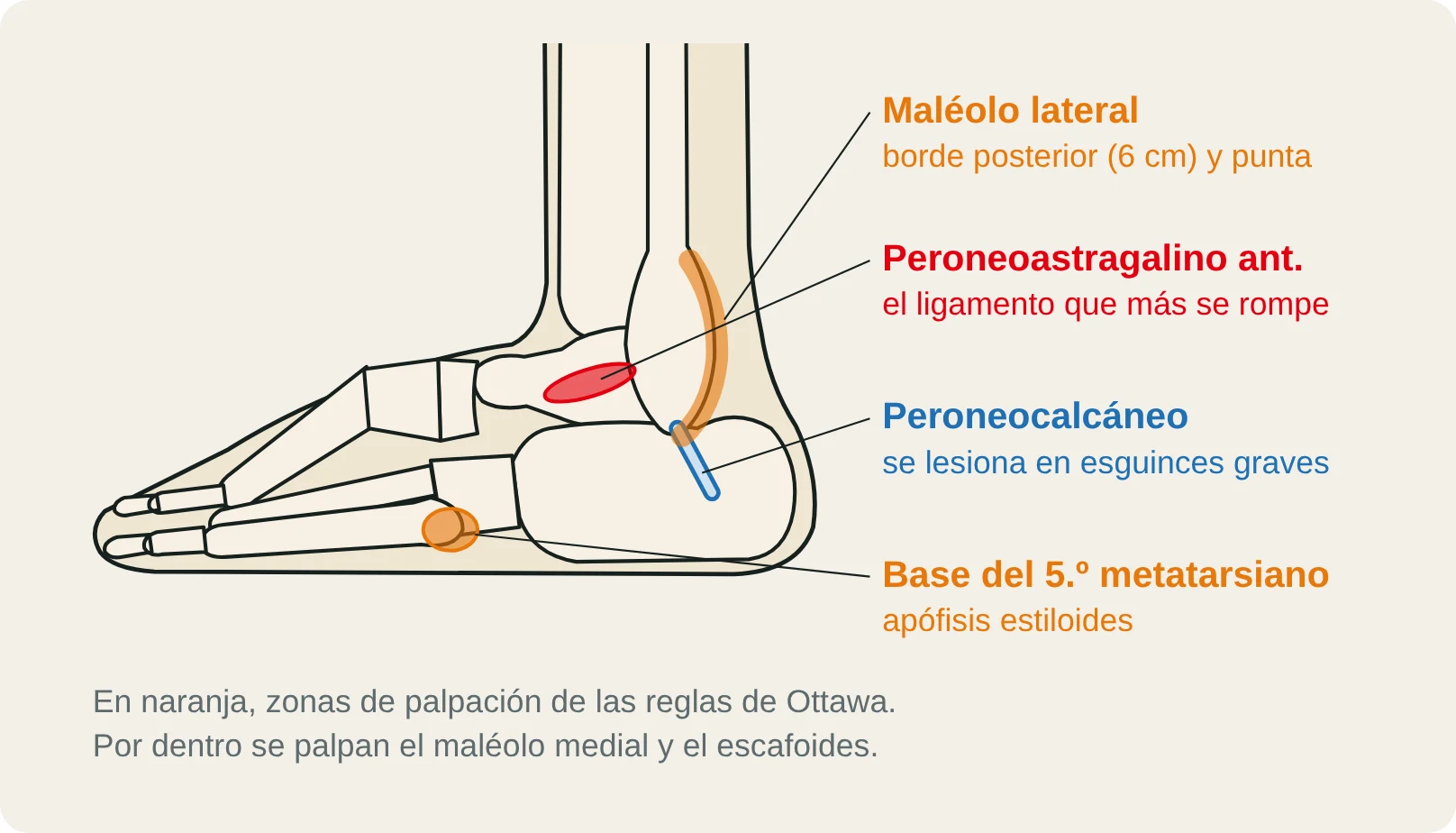 Vista lateral del tobillo con las zonas de palpación de las reglas de Ottawa (borde posterior y punta del maléolo lateral, base del 5.º metatarsiano), el ligamento peroneoastragalino anterior y el peroneocalcáneo.