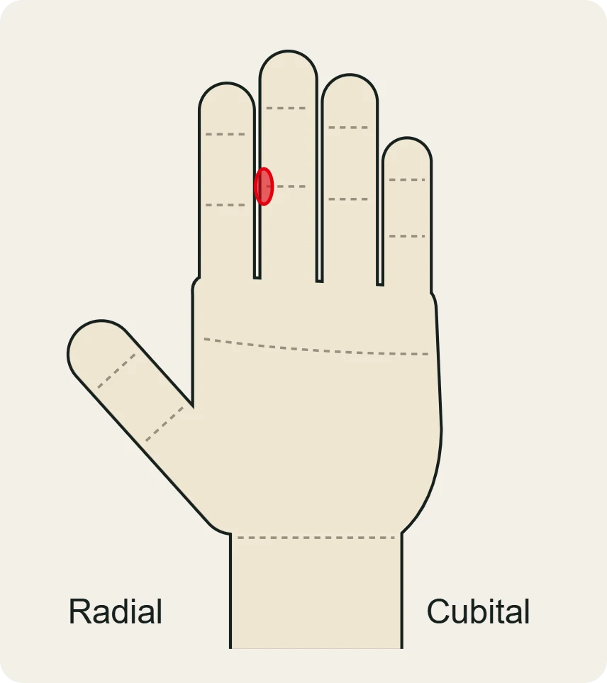 Ligamento colateral de la IFP: dolor en un lado de la articulación media del dedo.