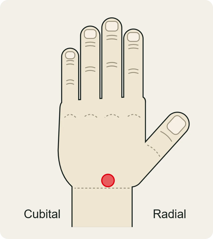 Ligamento escafolunar: dolor en el dorso de la muñeca, en el centro del carpo hacia el lado del pulgar.