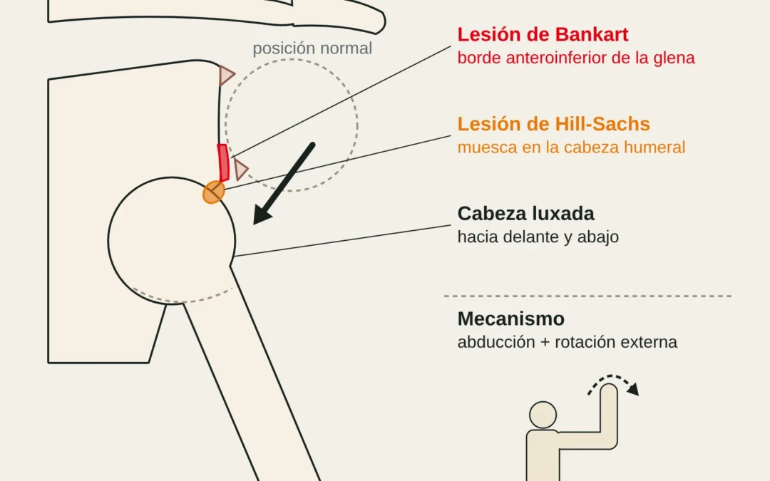 Vista frontal de una luxación anterior de hombro con las lesiones de Bankart y Hill-Sachs, y el mecanismo (abducción y rotación externa).