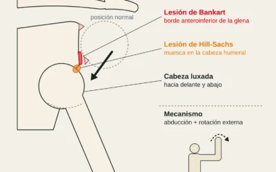 Luxación de hombro en escalada: qué hacer, recidivas y vuelta al muro