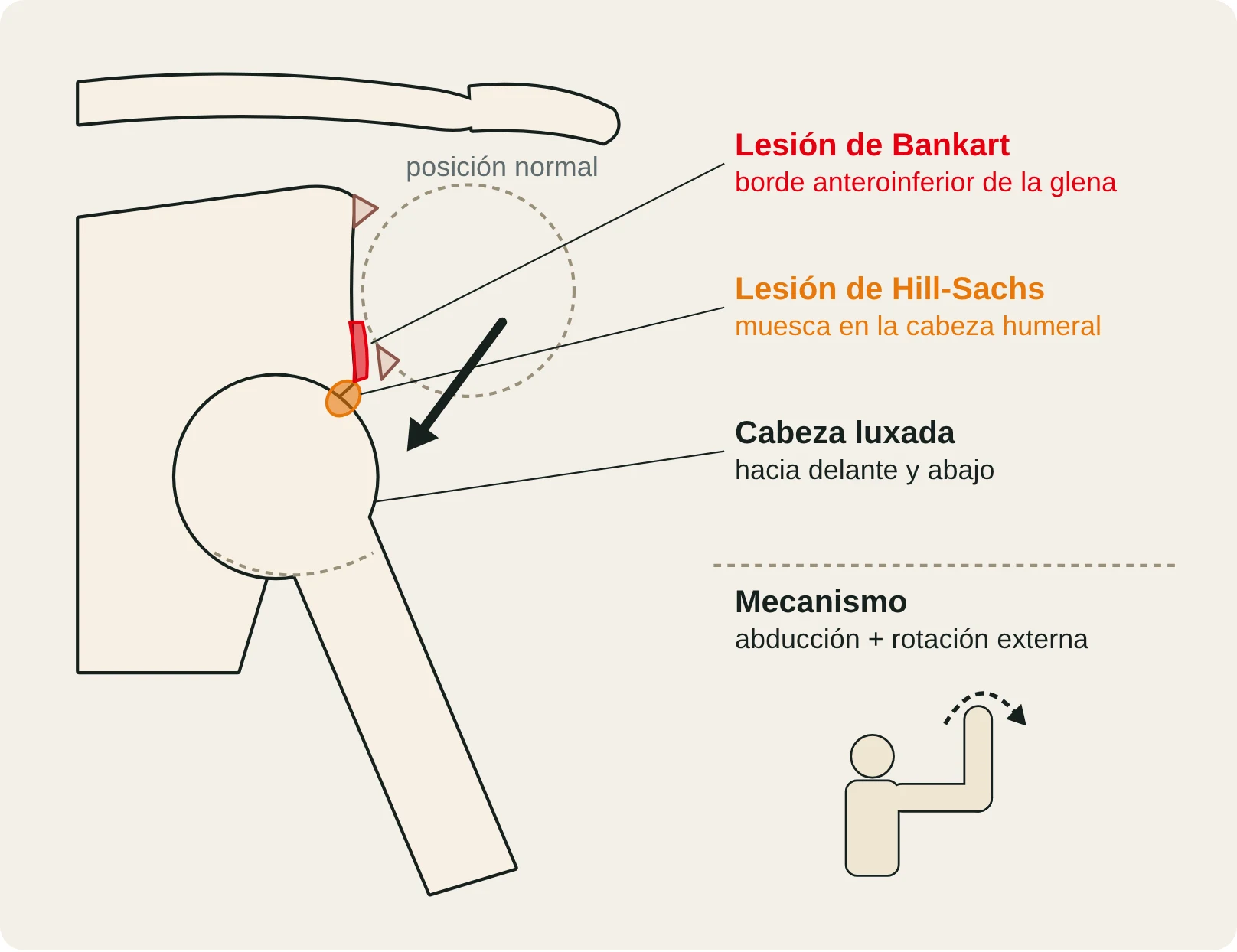 Vista frontal de una luxación anterior de hombro con las lesiones de Bankart y Hill-Sachs, y el mecanismo (abducción y rotación externa).