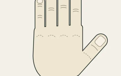Mallet finger (dedo en martillo) en escaladores: qué hacer si no puedes estirar la punta del dedo